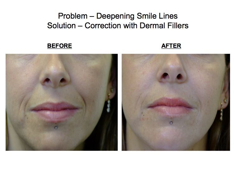 Lower Face Dermal Fillers